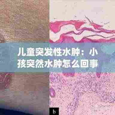 儿童突发性水肿:小孩突然水肿怎么回事