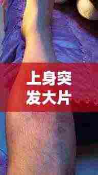 上身突发大片红斑，原因、症状与处理方法探讨